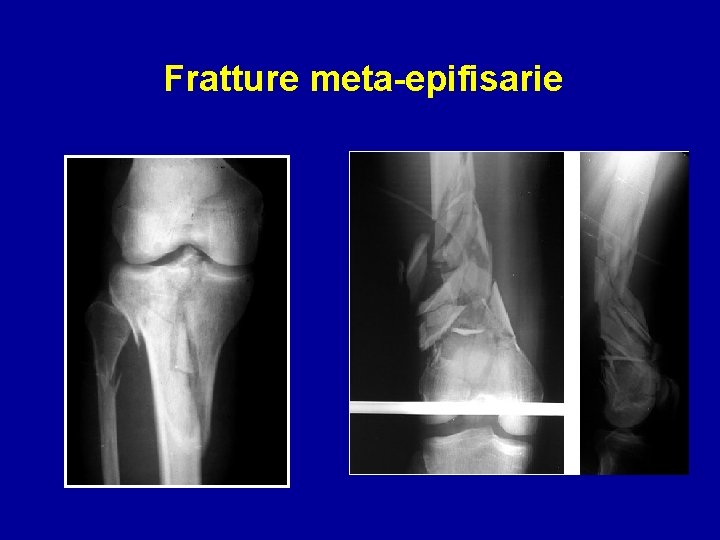 Fratture meta-epifisarie 