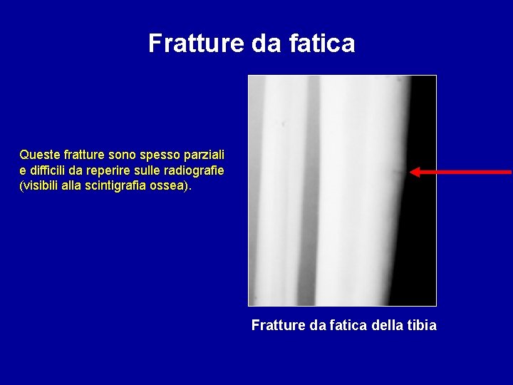 Fratture da fatica Queste fratture sono spesso parziali e difficili da reperire sulle radiografie