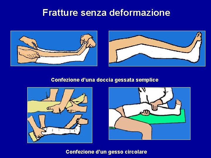 Fratture senza deformazione Confezione d’una doccia gessata semplice Confezione d’un gesso circolare 