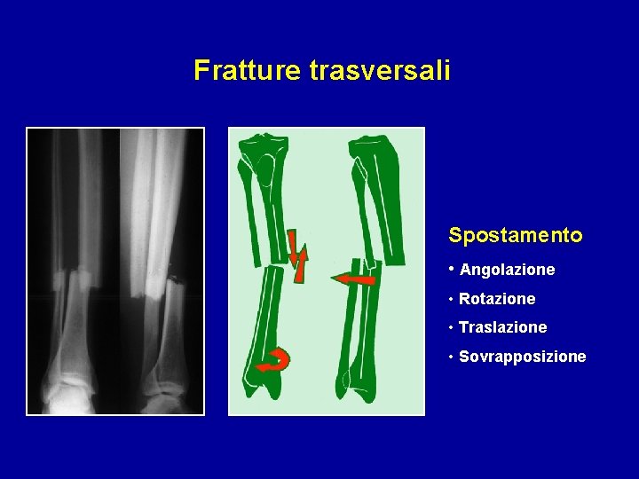 Fratture trasversali Spostamento • Angolazione • Rotazione • Traslazione • Sovrapposizione 