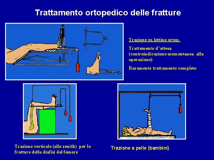 Trattamento ortopedico delle fratture Trazione su lettino ortop. Trattemento d’attesa (controindicazione momentanea alla operazione)