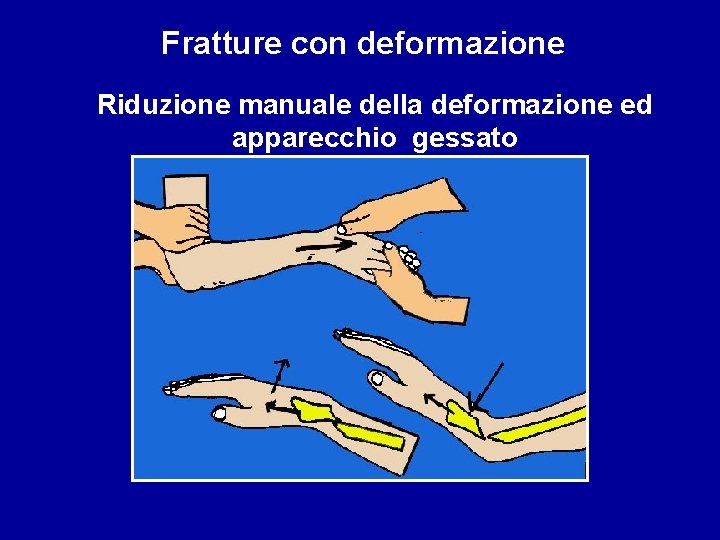 Fratture con deformazione Riduzione manuale della deformazione ed apparecchio gessato 