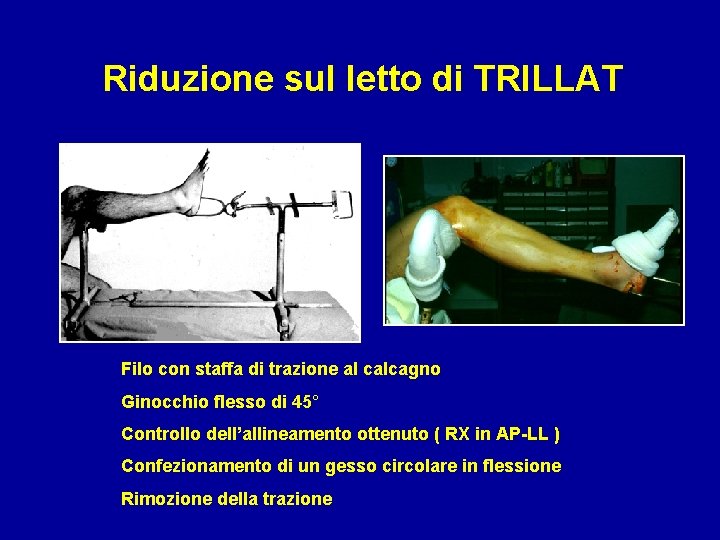 Riduzione sul letto di TRILLAT Filo con staffa di trazione al calcagno Ginocchio flesso