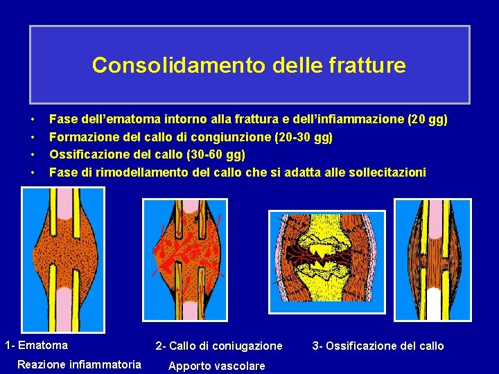 Consolidamento delle fratture • • Fase dell’ematoma intorno alla frattura e dell’infiammazione (20 gg)