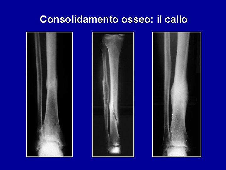 Consolidamento osseo: il callo 