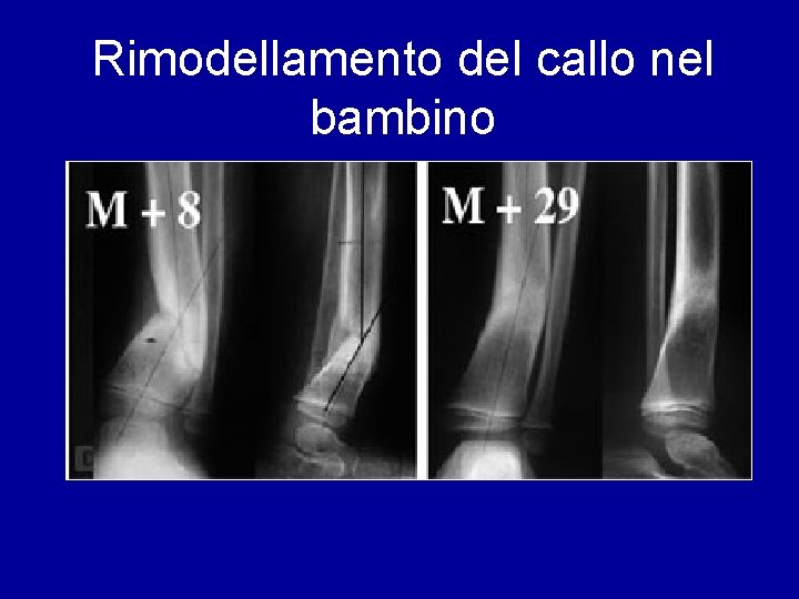 Rimodellamento del callo nel bambino 