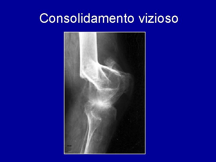 Consolidamento vizioso 