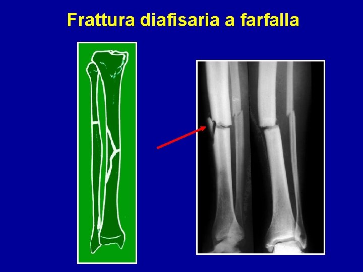 Frattura diafisaria a farfalla 