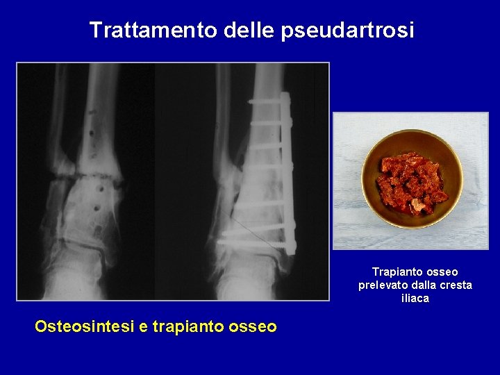 Trattamento delle pseudartrosi Trapianto osseo prelevato dalla cresta iliaca Osteosintesi e trapianto osseo 