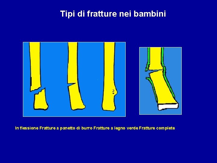 Tipi di fratture nei bambini In flessione Fratture a panetto di burro Fratture a