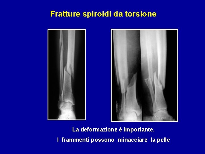 Fratture spiroidi da torsione La deformazione è importante. I frammenti possono minacciare la pelle