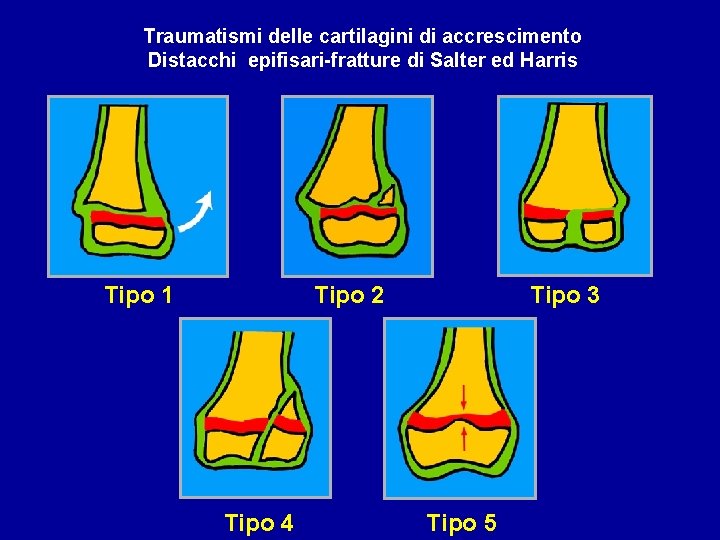 Traumatismi delle cartilagini di accrescimento Distacchi epifisari-fratture di Salter ed Harris Tipo 1 Tipo