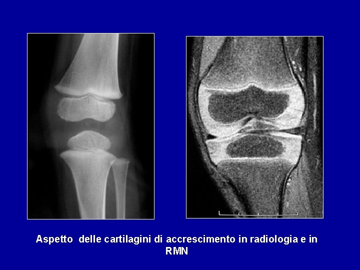 Aspetto delle cartilagini di accrescimento in radiologia e in RMN 