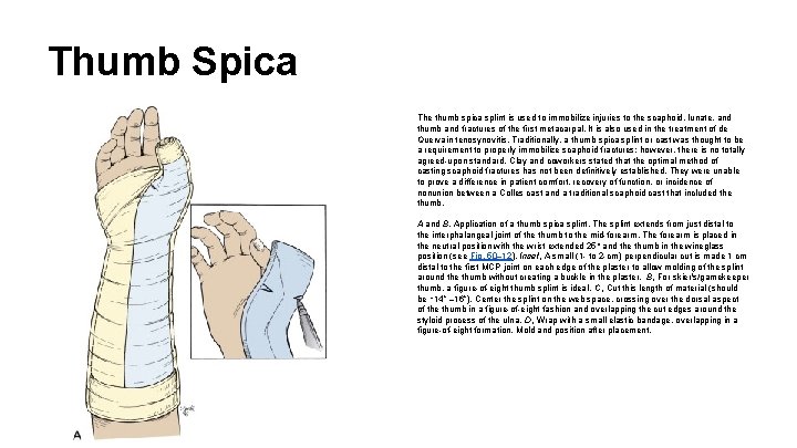 Thumb Spica The thumb spica splint is used to immobilize injuries to the scaphoid,