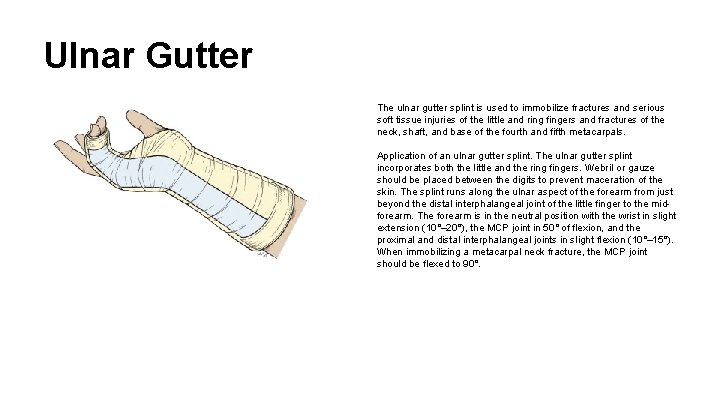 Ulnar Gutter The ulnar gutter splint is used to immobilize fractures and serious soft