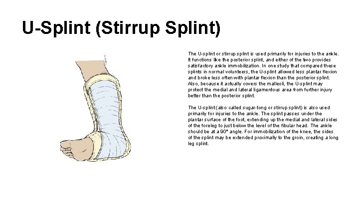 U-Splint (Stirrup Splint) The U-splint or stirrup splint is used primarily for injuries to