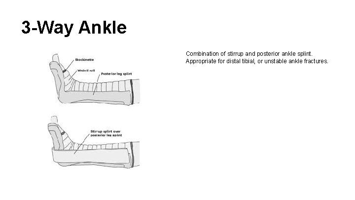 3 -Way Ankle Combination of stirrup and posterior ankle splint. Appropriate for distal tibial,