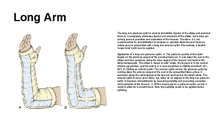 Long Arm The long arm posterior splint is used to immobilize injuries of the