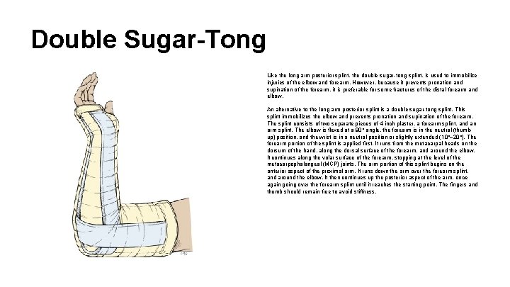 Double Sugar-Tong Like the long arm posterior splint, the double sugar-tong splint. is used