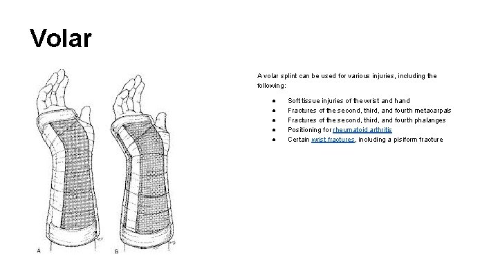 Volar A volar splint can be used for various injuries, including the following: ●