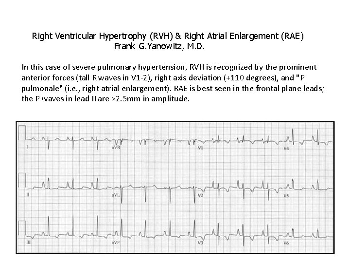 Right Ventricular Hypertrophy (RVH) & Right Atrial Enlargement (RAE) Frank G. Yanowitz, M. D.