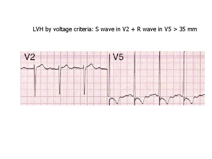 LVH by voltage criteria: S wave in V 2 + R wave in V