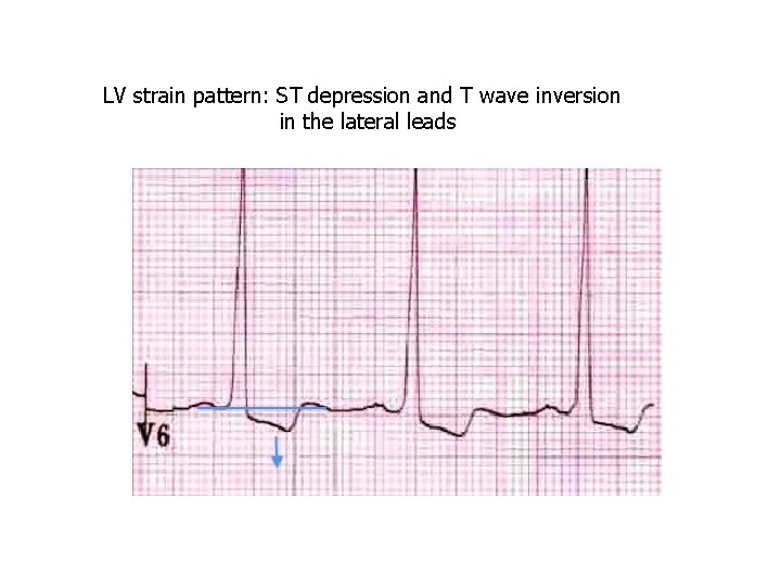LV strain pattern: ST depression and T wave inversion in the lateral leads 