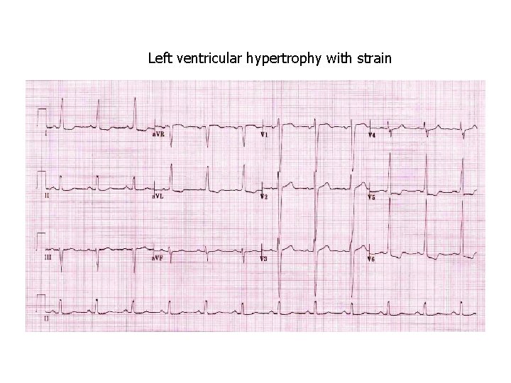Left ventricular hypertrophy with strain 