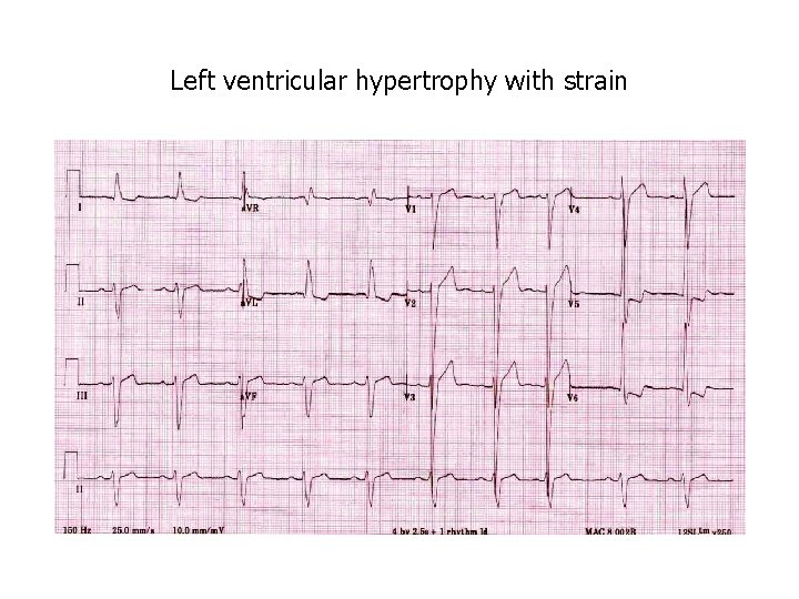 Left ventricular hypertrophy with strain 
