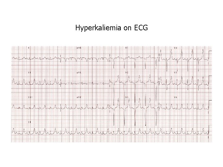 Hyperkaliemia on ECG 