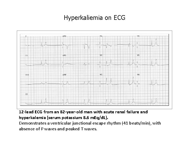 Hyperkaliemia on ECG 12 -lead ECG from an 82 -year-old man with acute renal