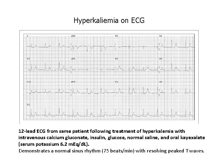 Hyperkaliemia on ECG 12 -lead ECG from same patient following treatment of hyperkalemia with