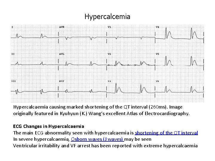 Hypercalcemia Hypercalcaemia causing marked shortening of the QT interval (260 ms). Image originally featured