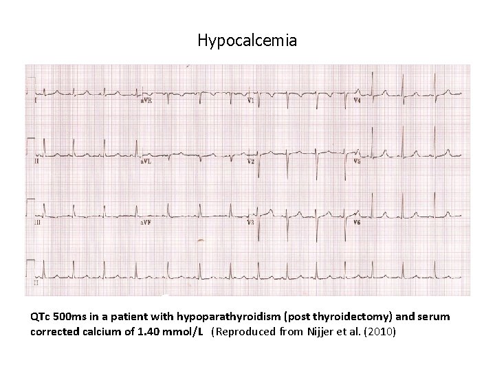 Hypocalcemia QTc 500 ms in a patient with hypoparathyroidism (post thyroidectomy) and serum corrected