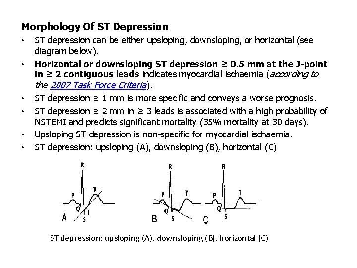 Morphology Of ST Depression • • • ST depression can be either upsloping, downsloping,
