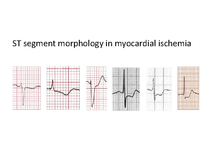 ST segment morphology in myocardial ischemia 