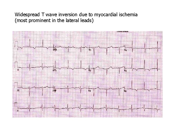 Widespread T wave inversion due to myocardial ischemia (most prominent in the lateral leads)