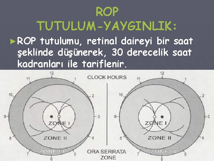 ► ROP TUTULUM-YAYGINLIK: tutulumu, retinal daireyi bir saat şeklinde düşünerek, 30 derecelik saat kadranları