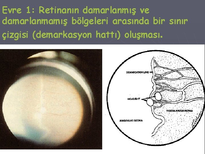 Evre 1: Retinanın damarlanmış ve damarlanmamış bölgeleri arasında bir sınır çizgisi (demarkasyon hattı) oluşması.