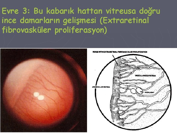 Evre 3: Bu kabarık hattan vitreusa doğru ince damarların gelişmesi (Extraretinal fibrovasküler proliferasyon) 