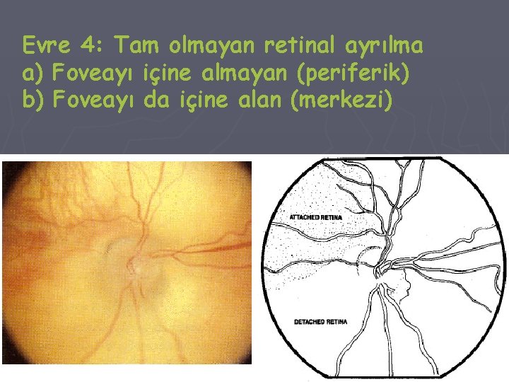 Evre 4: Tam olmayan retinal ayrılma a) Foveayı içine almayan (periferik) b) Foveayı da