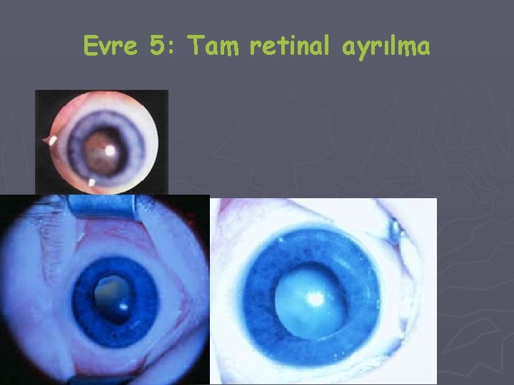 Evre 5: Tam retinal ayrılma 