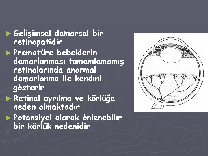 ► Gelişimsel damarsal bir retinopatidir ► Prematüre bebeklerin damarlanması tamamlamamış retinalarında anormal damarlanma ile