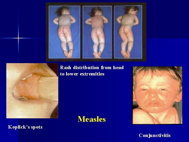 Rash distribution from head to lower extremities Measles Koplick’s spots Conjunctivitis 