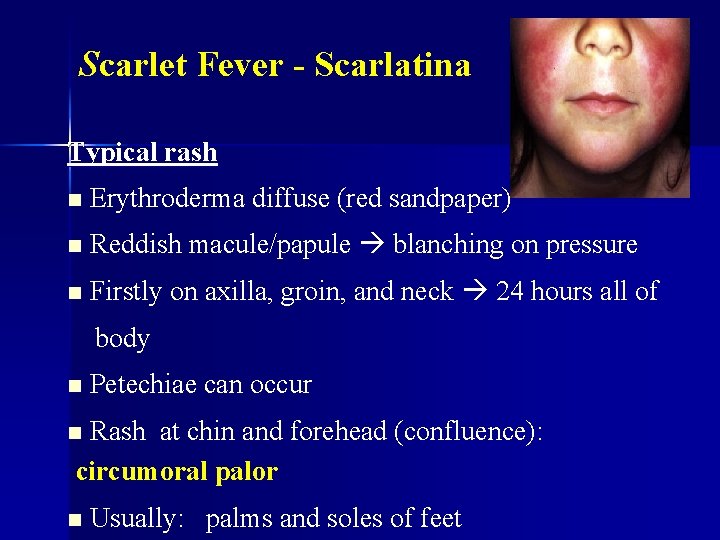 Scarlet Fever - Scarlatina Typical rash n Erythroderma diffuse (red sandpaper) n Reddish macule/papule