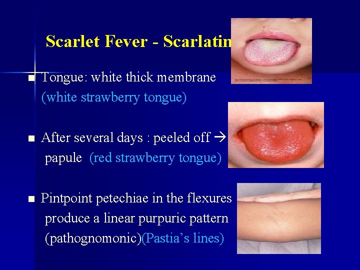 Scarlet Fever - Scarlatina n Tongue: white thick membrane (white strawberry tongue) n After