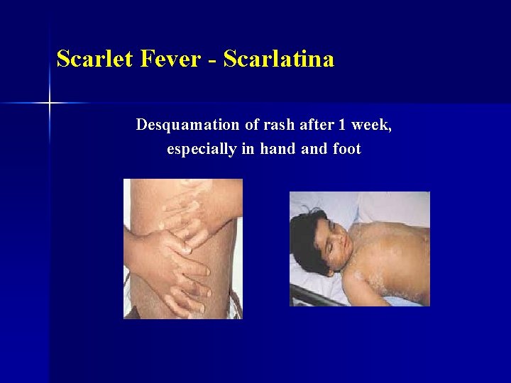 Scarlet Fever - Scarlatina Desquamation of rash after 1 week, especially in hand foot