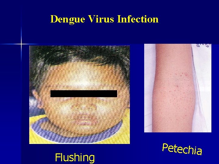 Dengue Virus Infection Flushing Petechia 