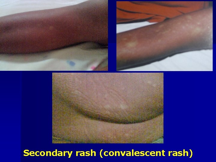 Secondary rash (convalescent rash) 