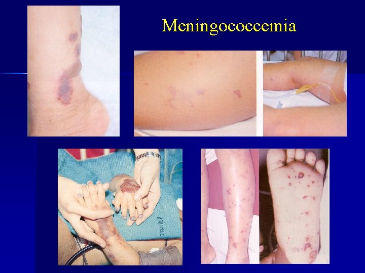 Meningococcemia 